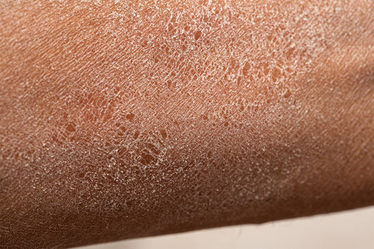 Dry Patches on My Skin: 6 Potential Causes & How To Help Ease Them