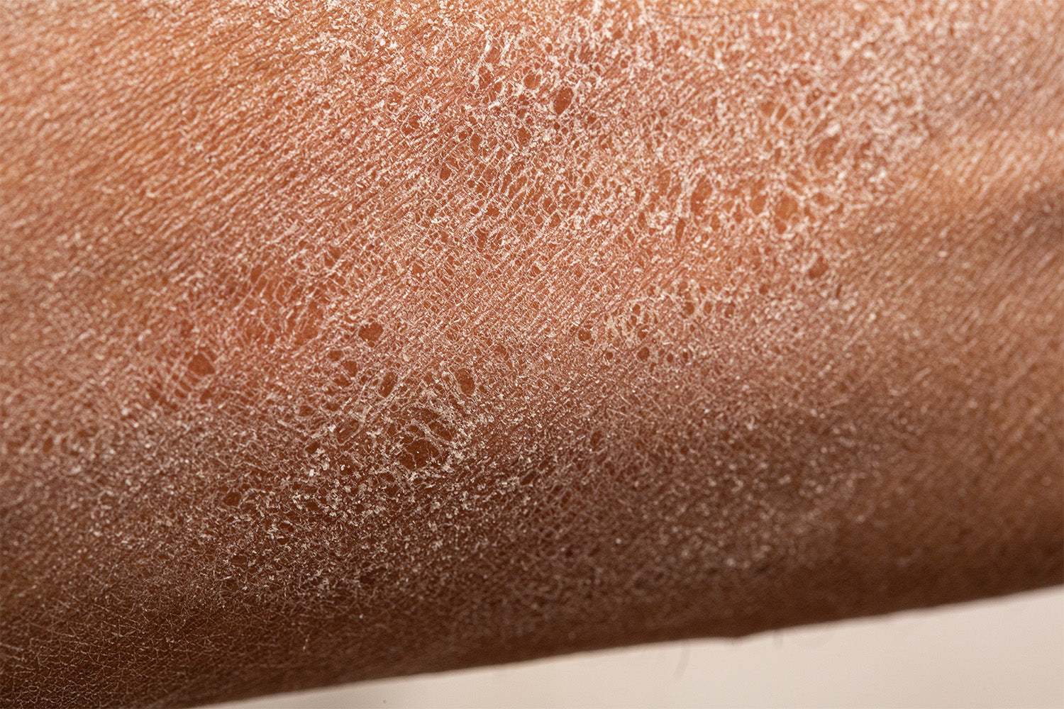 6 Causes of Dry Patches on Your Skin & What To Do | iwi life